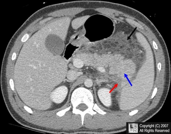 imagini abces pancreatic